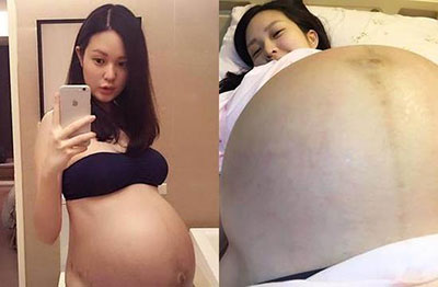 台女星怀双胞胎时孕肚惊人 产后1天瘦20斤